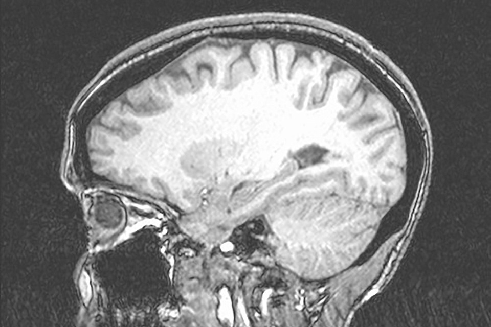 Mental Health brain scan